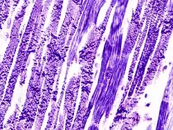Contraction band necrosis. PTAH.