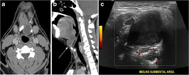 Fig. 20. Recurrent/residual thyroglossal duct cyst in a 39-year-old male patient. The first resection of thyroglossal duct cyst showed histopathology evidence of Hurthle cell type thyroid cancer. However, the second resection showed signs of chronic inflammation, with no malignant cells. a, b Enhanced axial and sagittal neck CT scans demonstrate a unilocular cystic lesion arising from the tongue base and extending through the partially resected hyoid bone. This cystic lesion has a peripheral enhancing wall, which becomes more thick over its inferior aspect associated with surrounding fat stranding at the surgical site (white arrow). There are no internal septations, nodules or masses, or calcifications. c Transverse view of power Doppler ultrasound at the submental area demonstrates cystic lesion and internal debris with no detected internal vascularity.