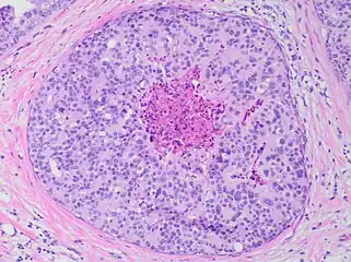 Ductal carcinoma in situ with comedo necrosis spanning 30% of its diameter, which is generally regarded as the minimal size to classify it as comedo.