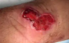 Úlcera causada por Mycobacterium ulcerans.