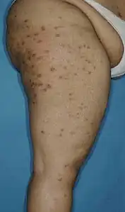 Escoriação em Ponto