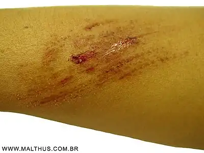 Escoriação em Pincelada