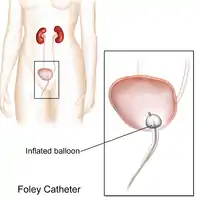 Cateter Foley/Permanente