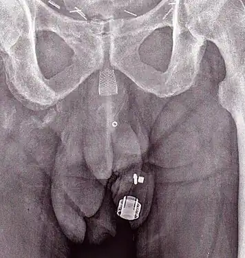 Uma imagem de raio X de um ZSI 375 implantado. O aparelho está desativado - a mole está comprimida abaixo do topo do cilinder. O paciente está continente.